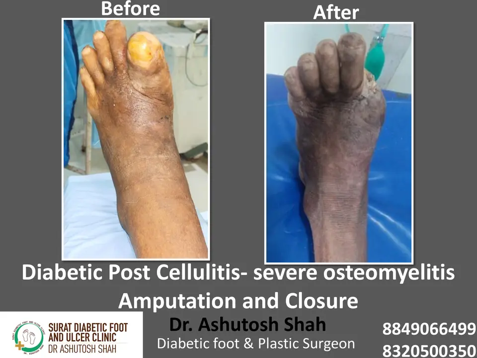 Diabetic Foot  PPT sunita.pptx-10.webp